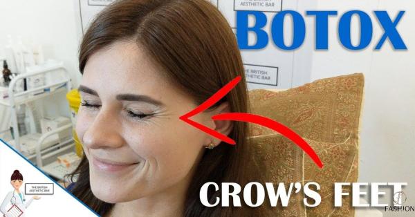 Is Botox Effective for Treating Crow’s Feet (1)