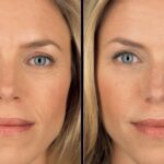 Juvederm Filler vs Botox The 7 Main Differences You Need to Know