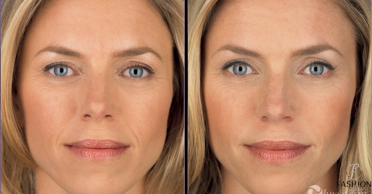 Juvederm Filler vs Botox The 7 Main Differences You Need to Know